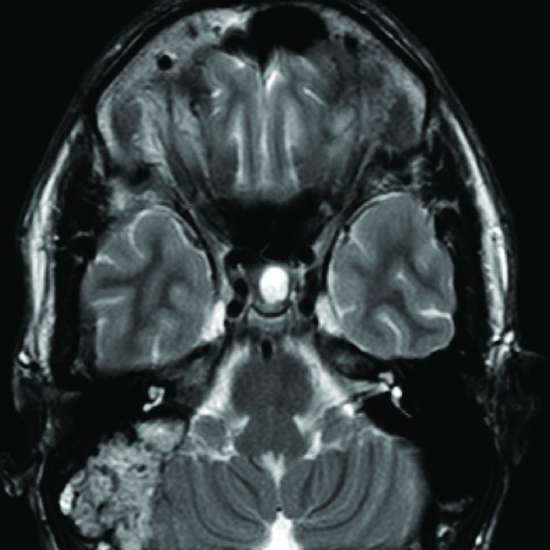 A Complete Guide To Temporal Bone Uses, Preparation, Procedure and Benefits